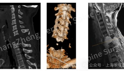 全球罕见!中国医生救回“身首离断”患者