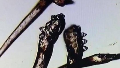 11岁女孩眼痒眼痛，竟是睫毛“养了”10条螨虫！医生：不良生活习惯是帮凶